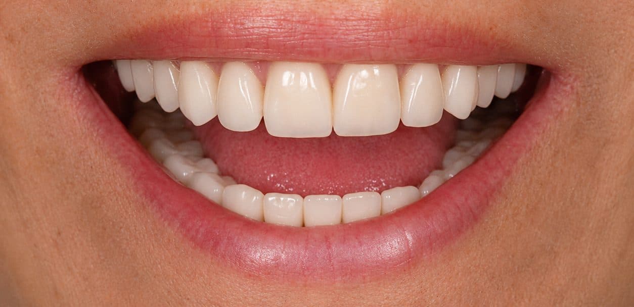 A full-mouth restoration rebuilding severely damaged teeth with implants and crowns, after treatment