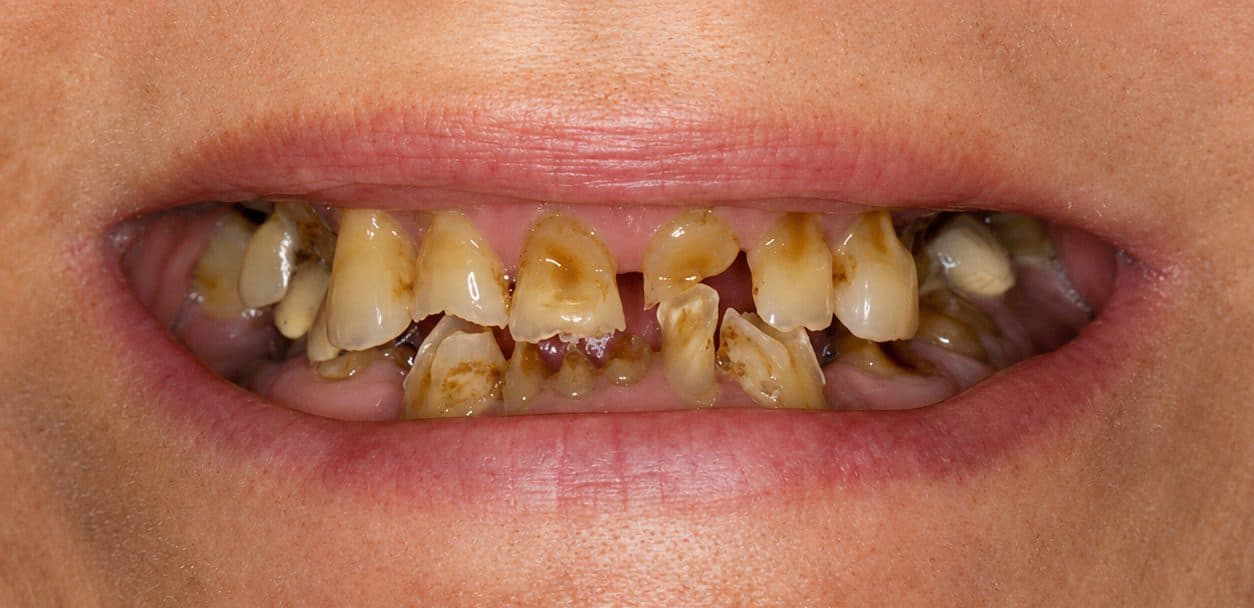 A full-mouth restoration rebuilding severely damaged teeth with implants and crowns, before treatment