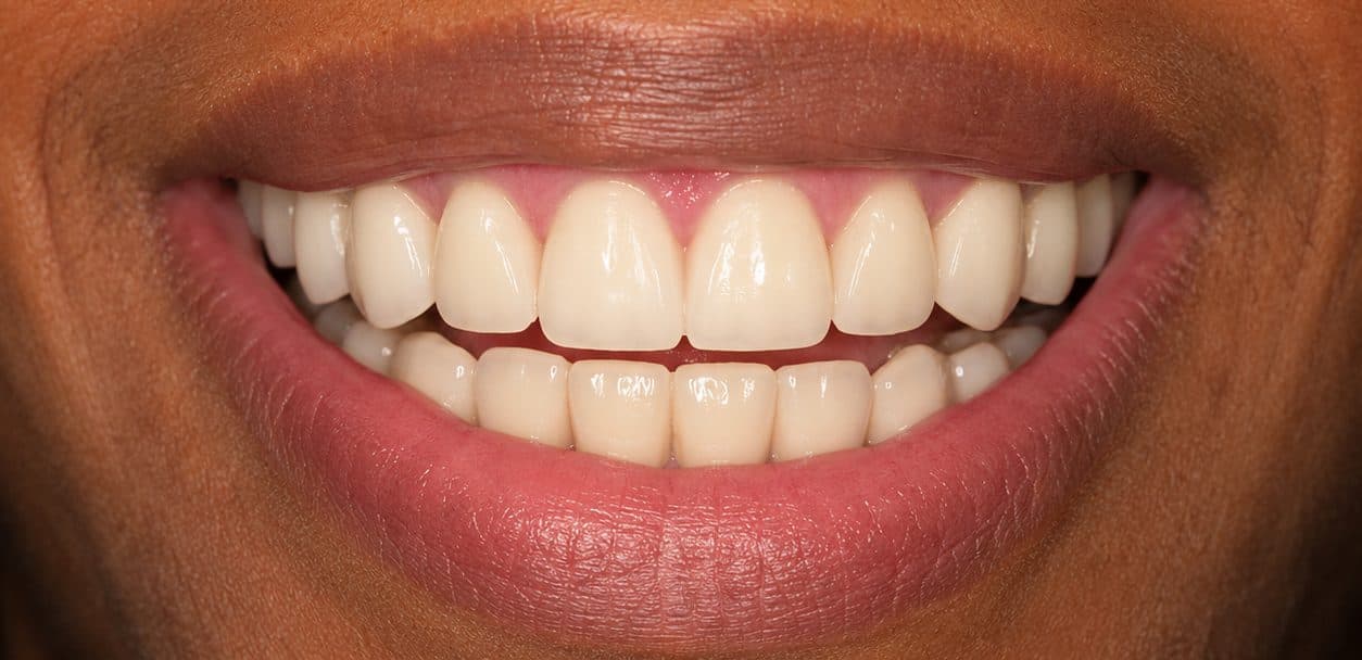 A dental implant restoring a missing front tooth and healed gum line, after treatment