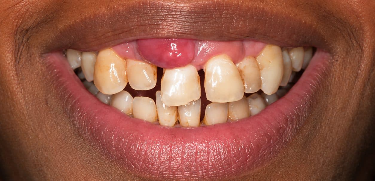 A dental implant restoring a missing front tooth and healed gum line, before treatment