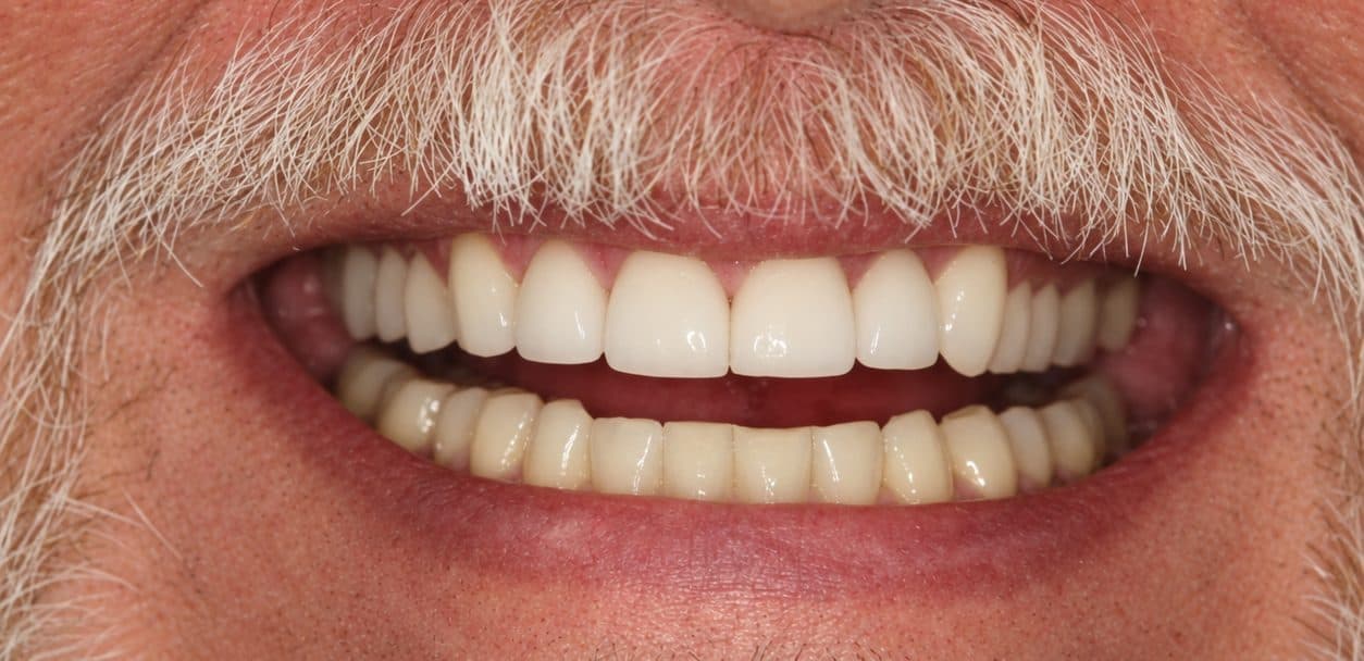 A veneer smile makeover closing gaps and rebuilding worn teeth, after treatment