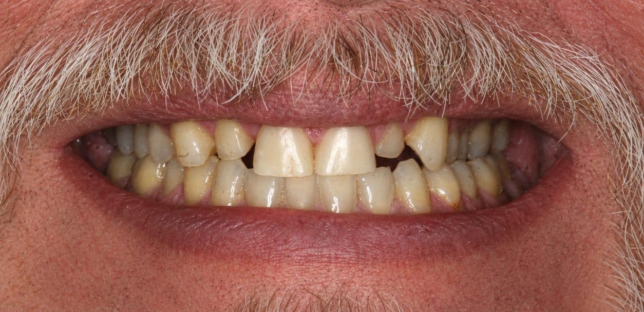 A veneer smile makeover closing gaps and rebuilding worn teeth, before treatment